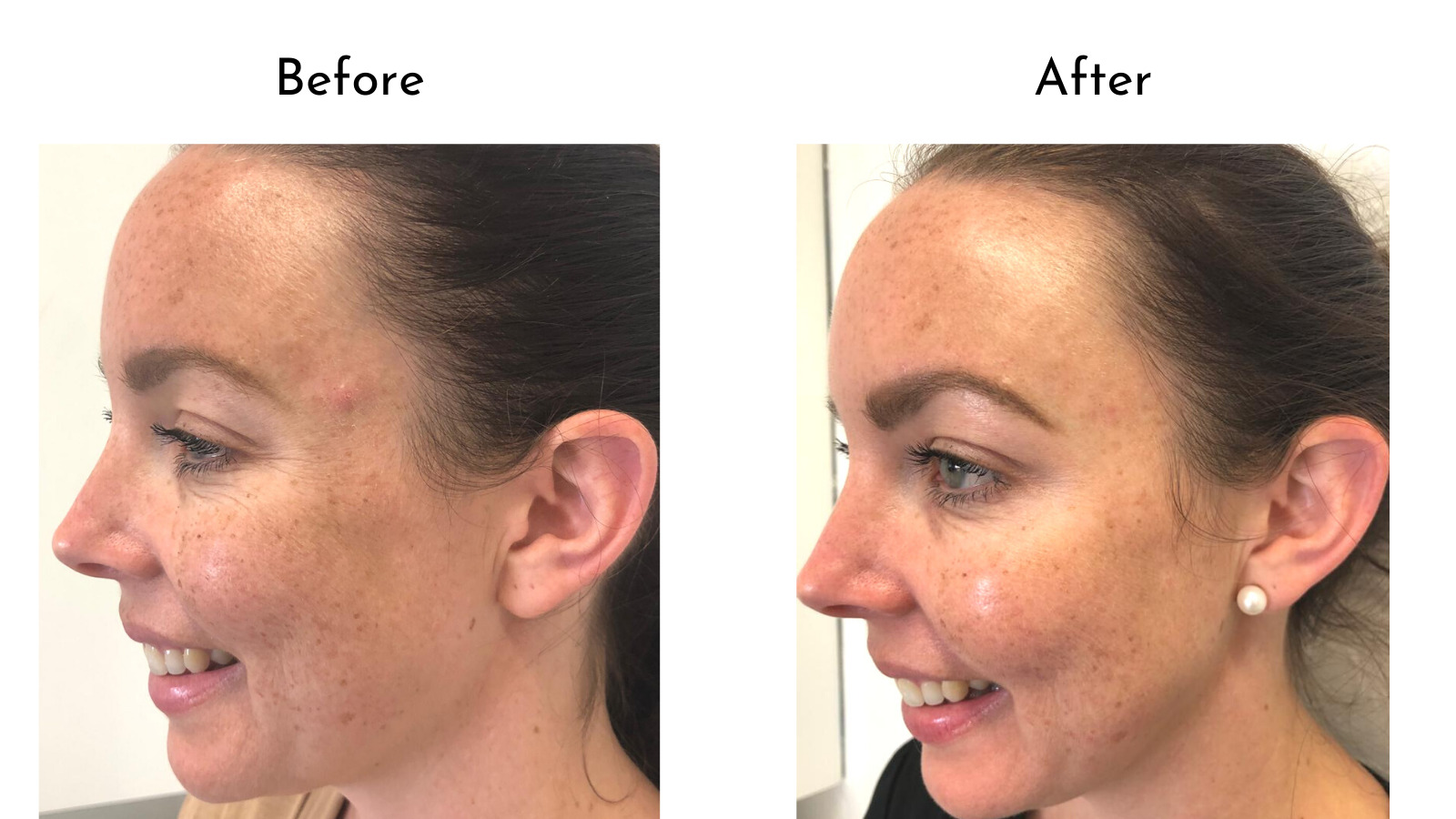 Botox before and after comparison crows feet