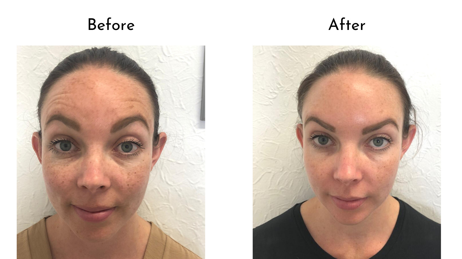 forehead Botox before and after photo comparison 