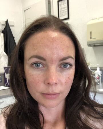 Botox after injections