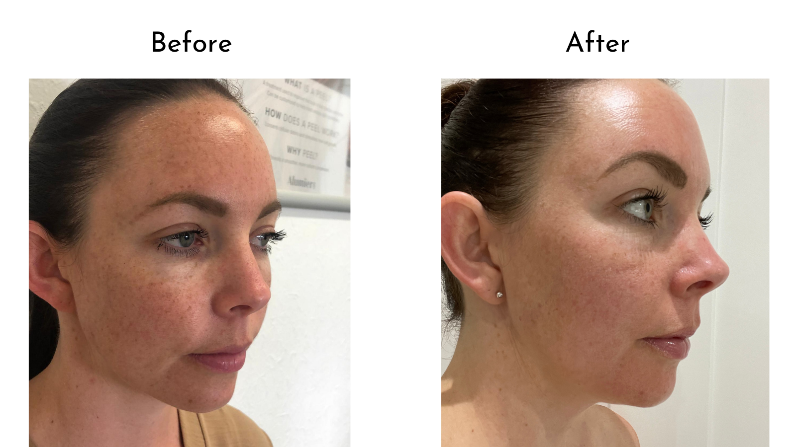 Hyperpigmentation Treatment - Before & After
